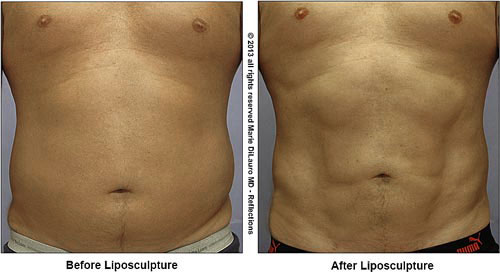 Liposuction-to-abdomen-for-definition-marie-dilauro-md-reflections-614-885-3500